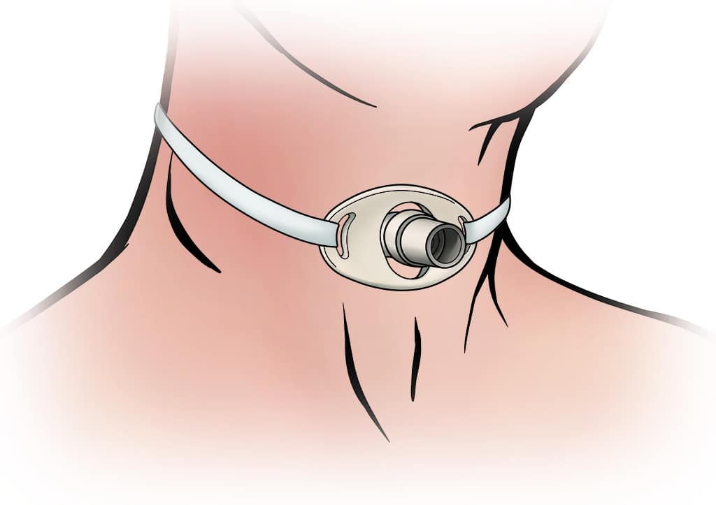 Evde Trakeostomi ve Kolostomi Bakımı